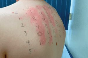 A close up of the back of a person who has had a skin prick test for allergies